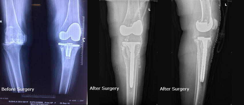 Top Revision Knee Replacement Surgeon in Delhi, India