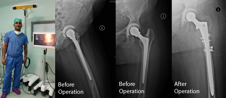 Best Revision Total Hip Replacement In Delhi, India